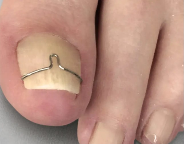 Встановлення титанової нитки Київ | Лікування та корекція нігтів у Podo-Terra 1