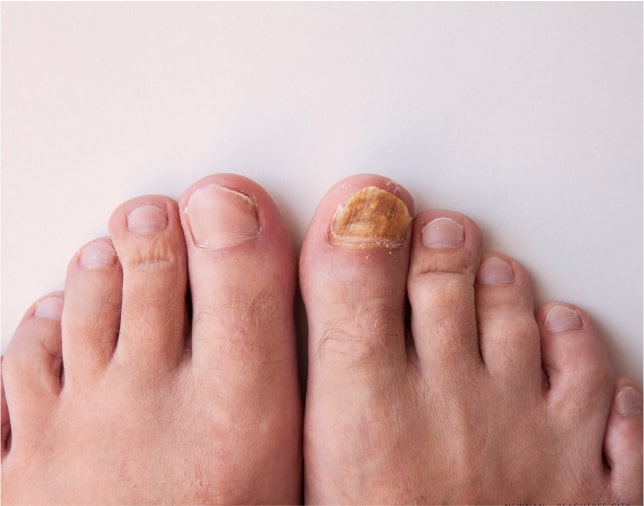 Лікування грибка нігтів, видалення інфікованих нігтів у Києві - діагностика, ціна 5