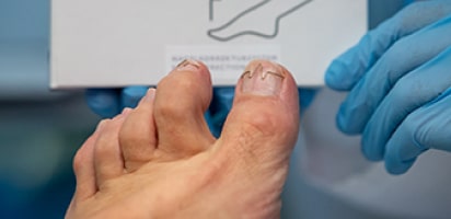 Встановлення скоби Фрезера Київ – корекція врослого нігтя без операції 4