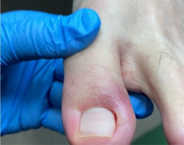 Лікування та видалення врослого нігтя в Києві - Podo-Terra 1