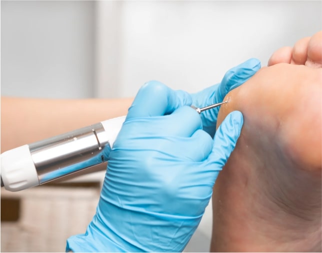 Лікування та видалення мозолів на стопі у Києві | Подологічний центр Podo-Terra 3