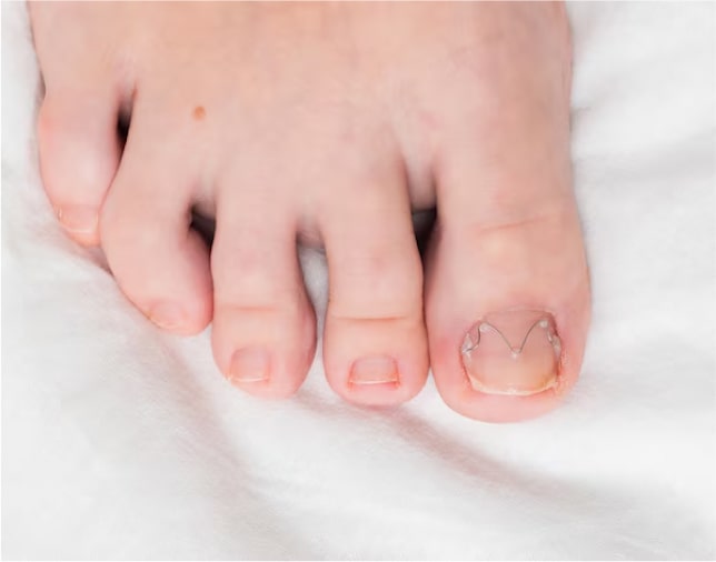 Встановлення скоби Фрезера Київ – корекція врослого нігтя без операції 5