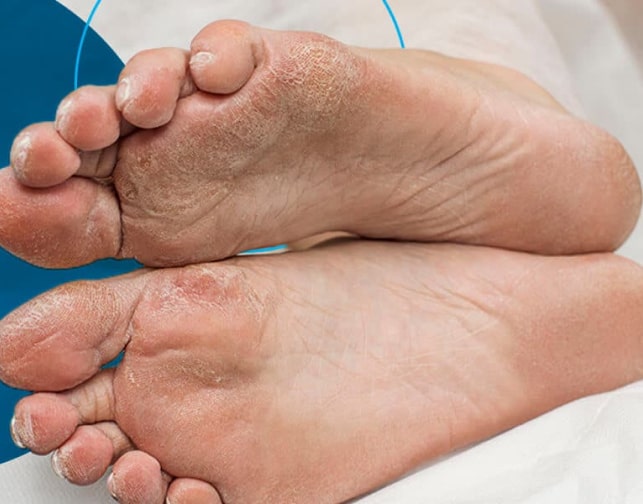 Педикюр для діабетиків у Києві – ціни на послуги педикюру діабетичної стопи 1