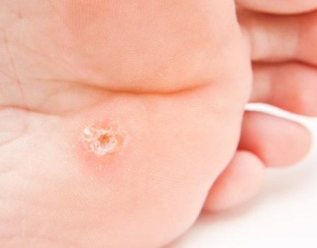 Видалення бородавок на ногах у Києві - лікування ВПЛ у подолога | Podo-Terra 1