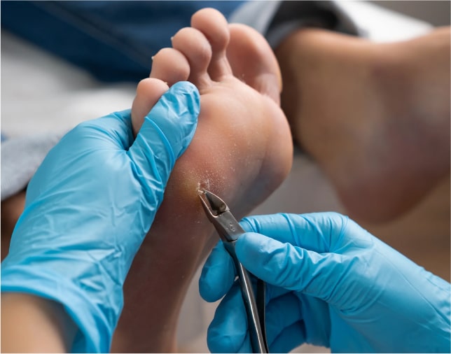 Обробка та видалення мозолів на п'ятах Київ | Подологічний центр Podo-Terra 1