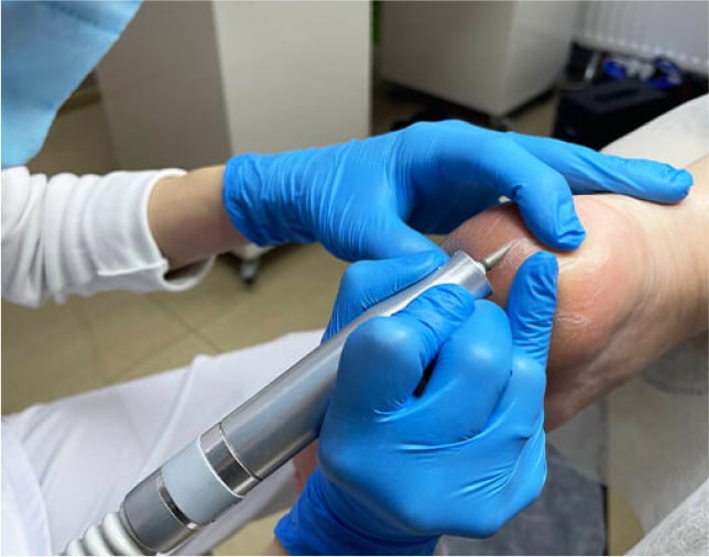 Лікування тріщин на ногах у Києві — професійний догляд у центрі Podo-Terra 5