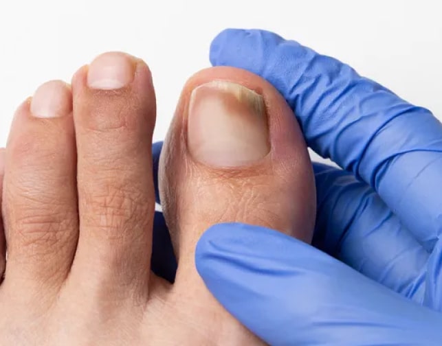 Лікування деформованих нігтів у Києві — подолог Печерськ, ціни, консультація 9