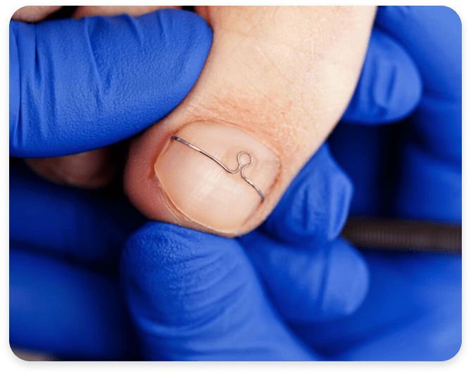 Встановлення скоби Фрезера Київ – корекція врослого нігтя без операції 9