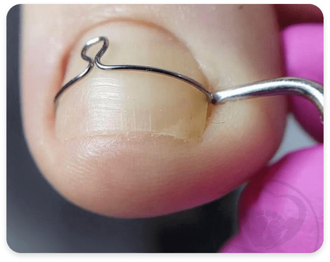 Встановлення скоби Фрезера Київ – корекція врослого нігтя без операції 10