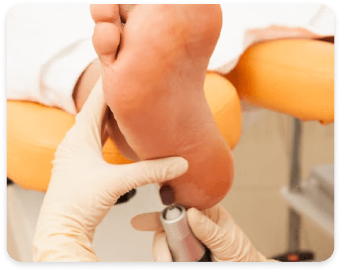 Обробка та видалення мозолів на п'ятах Київ | Подологічний центр Podo-Terra 10