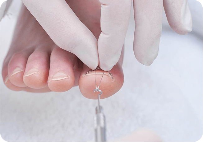 Корекційні системи для нігтів у Києві - ортоніксія 8